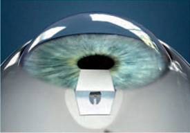 Лазерное лечение глаукомы в Крыму